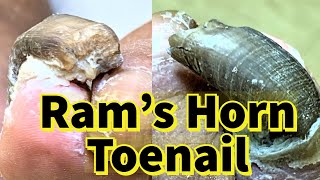 Rams Horn Toenail Severe Fungal Toenail [upl. by Arerrac]