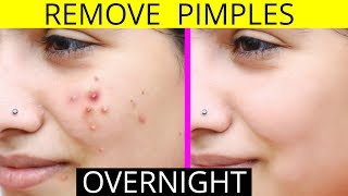 How To Remove Pimples Overnight  Acne Treatment  Anaysa [upl. by Ajssatsan]