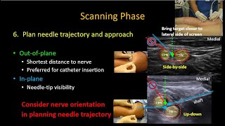 USguided Popliteal Sciatic Nerve Block [upl. by Kemeny]