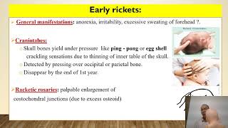 Rickets in children [upl. by Nyladgam]