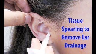 Tissue Spears to Remove Ear Drainage [upl. by Sokin]