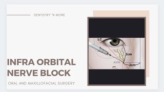 INFRA ORBITAL NERVE BLOCK [upl. by Anehsat745]