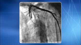 Chapter 5 Subclavian Innominate amp Aortic Arch Regions [upl. by Moriah809]