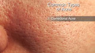 Acne Treatment Options [upl. by Blumenthal306]