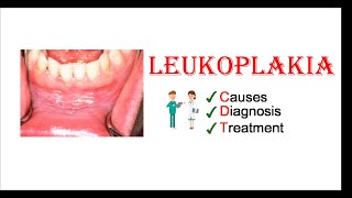 Leukoplakia  Causes Diagnosis amp Treatment [upl. by Tioneb]