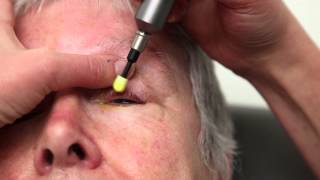 Blepharitis Treatment That Really Works Blephex Eyelid Cleaning [upl. by Harvey]