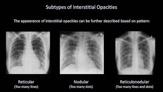 How to Interpret a Chest XRay Lesson 7  Diffuse Lung Processes [upl. by Verne]