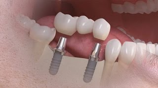 Straumann  Tratamento de vários dentes com solução implantosuportada [upl. by Harrie]