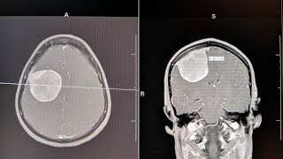 Brain Tumor Symptoms Described [upl. by Eade]