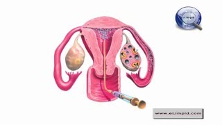 Intrauterine insemination  IUI Success Rates [upl. by Eyde62]