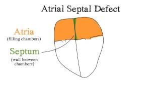 Atrial Septal Defect ASD [upl. by Shepard]