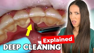 Dental Hygienist Explains Deep Cleaning Procedure [upl. by Juback]