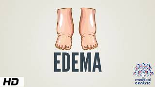 Edema Causes Signs and Symptoms Diagnosis and Treatment [upl. by Ecnarretal854]