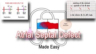 Atrial Septal Defect Closure9 Frequently Asked Questions [upl. by Lamak]