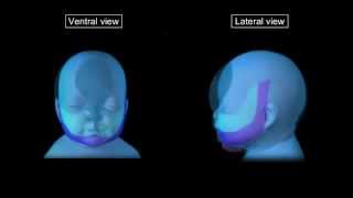 Cleft Lip and Palate  Pathophysiology Causes amp Management [upl. by Zetneuq20]