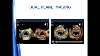 Guidelines for Performing a Comprehensive Transesophageal Echocardiographic Examination [upl. by Silsbye]