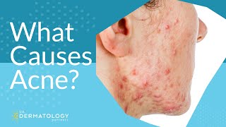 What Causes Acne  Explained by Dermatologist [upl. by Notxap]