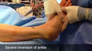 The Guaranteed FASTEST Ankle Sprain Treatment Doctor Approved [upl. by Enyaw258]