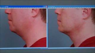 Smartlipo of the Neck  Case Study  Dr Sterry [upl. by Eurd675]