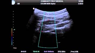 Ultrasound Guided Occipital Nerve Block [upl. by Cos598]