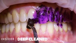 How Teeth Are Professionally Deep Cleaned  Deep Cleaned [upl. by Mabelle]