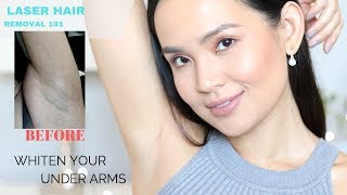 The TRUTH About Laser Hair Removal My Experience  How to lighten underarms [upl. by Kulsrud848]