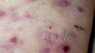 Cystic Acne Cysts Acne Dermatology Comedones and Whiteheads [upl. by Llert]