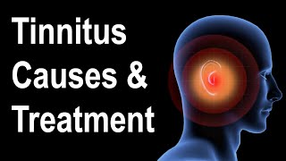 What is Tinnitus Causes amp Treatment Strategies [upl. by Radke]