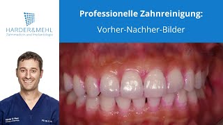 Professionelle Zahnreinigung VorherNachherBilder [upl. by Dukie690]