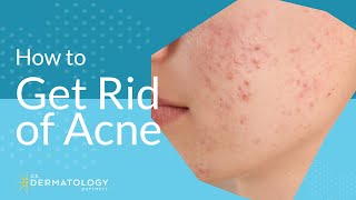 Acne Treatment  Explained by Dermatologist [upl. by Atteugram]