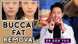 All About Buccal Fat Removal Surgery and Recovery  Dr Donald B Yoo [upl. by Hoye]