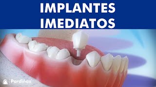 Implantes imediatos após a extração do dente © [upl. by Ahtikal]