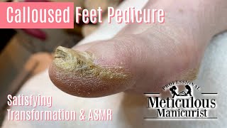 How to Pedicure Extremely Calloused Feet and Toes ASMR [upl. by Rehsu]