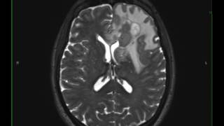 Grade 3 Anaplastic Astrocytoma [upl. by Assi]