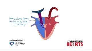 Ventricular Septal Defect [upl. by Vivienne]