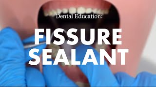 Placement of a Fissure Sealant [upl. by Nosnorb246]