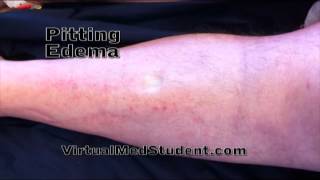 Pitting Edema Physical Exam Finding [upl. by Neerhtak866]