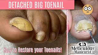 How To Pedicure Transformation for Men on Detached Toenails [upl. by Enaek]