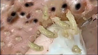 Pimple Popping 2020 Video 40 Blackheads removal Acne removal acne treatment [upl. by Talie]