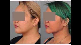 Chin Liposuction With Smartlipo™  Watch Dr Sterry [upl. by Enahsed32]