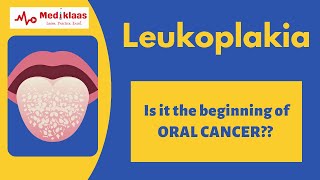 Leukoplakia l Precancerous lesions l Oral pathology l Mediklaas [upl. by Kirshbaum472]