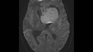 Anaplastic Ependymoma [upl. by Nairbal]