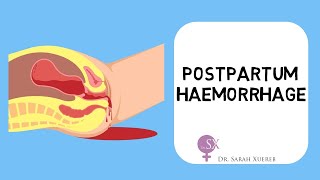 Postpartum Haemorrhage [upl. by Akienaj]