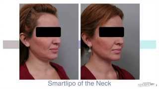 Double Chin Liposuction With Smartlipo™  Dr Sterry Explains [upl. by Githens]