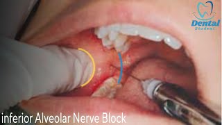 Inferior alveolar nerve block amp Live demo بشرح مفصل [upl. by Bent]