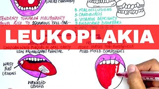 Leukoplakia  Causes Diagnosis amp Treatment [upl. by Ardeha213]