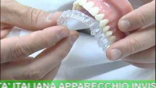 ODONTOIATRIA Invisalign  Apparecchio Invisibile [upl. by Riatsila847]