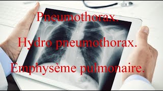 Pneumothorax  Hydro pneumothorax  Emphysème pulmonaire [upl. by Aridni842]