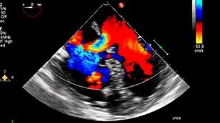 Ventricular Septal Defect VSD  Heart Auscultation  Episode 11 [upl. by Creath]