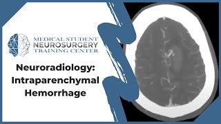 Neuroradiology Intraparenchymal Hemorrhage [upl. by Layap]